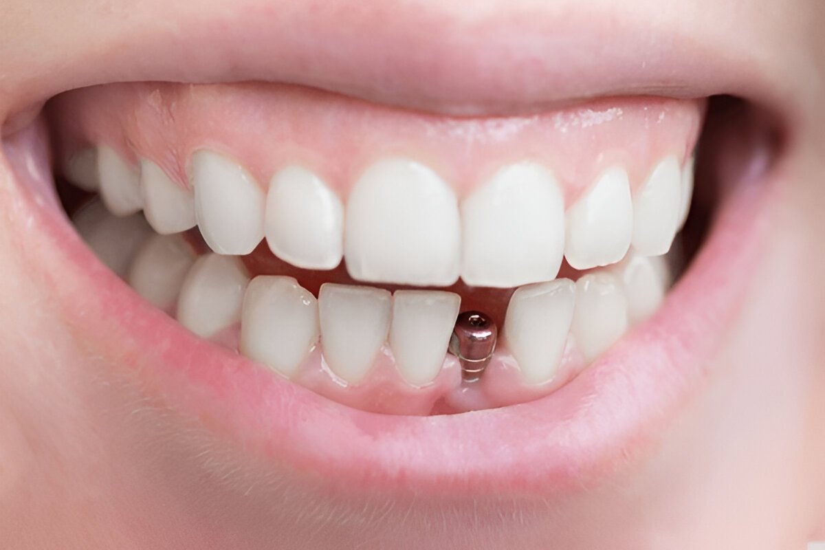Single Tooth Dental Implants